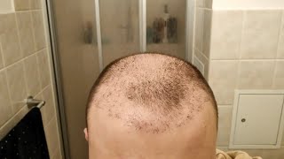 I Stopped Taking Finasteride after Hair Transplant  1 Year Hair Loss Experiment [upl. by Terrab947]