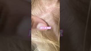 Nits on hair l lice removal service explore hairtok headlice hair [upl. by Loggia]