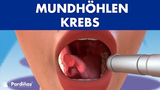 MUNDHÖHLEN KREBS  Symptome Ursachen und Arten von mundkrebs © [upl. by Akcirehs]