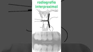 técnicas radiográficas intrabucais [upl. by Acireh]