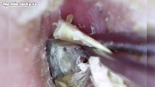 Ear Wax Removal 110 Itching All Day Because Of Dry And Thick Earwax  Ear Cleaning ASMR [upl. by Soilisav]