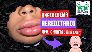 ANGIOEDEMA HEREDITARIO [upl. by Assirram]