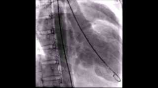 Mitral Valve prolapse [upl. by Schertz]