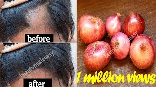 Grow your Hair Faster with Onion Juice  STOP Hair Fall with Home Remedy  100 Working [upl. by Lati]