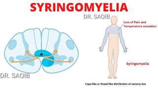 Syringomyelia [upl. by Burke]