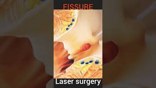 Fissure Treatment Laser Surgery [upl. by Rexer]