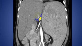 RADIOLOGY ROUNDS 036 SPLENOMEGALY [upl. by Eiuqnimod]