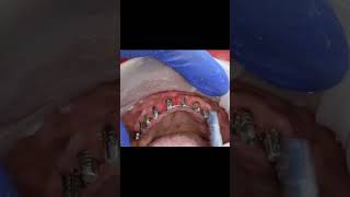 Soft bone maxilla full arch dental implants with intraoral welding post 6 months tapping test [upl. by Notrom]