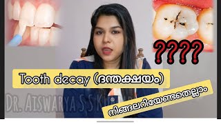 Tooth decayദന്തക്ഷയം and treatments DrAiswaryaSreekumar [upl. by Ahsuat]