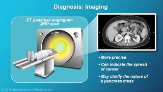 Pancreatic Cancer Pathophysiology Diagnosis and Staging [upl. by Sonitnatsnoc]