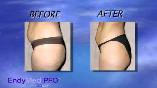 ENDYMED 3Deep Skin Tightening amp Body Contouring  Austin Dermatology [upl. by Vittorio]