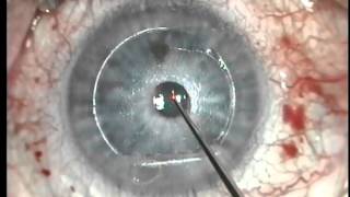 Raindrop ReVision Optics Inlay for Presbyopia Insertion Technique [upl. by Leamhsi607]