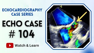 ECHO Case 104  Echocardiography for Beginners  Fever in a Child [upl. by Vey]