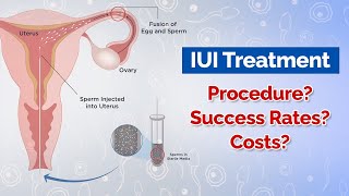 IUI Treatment Procedure Costs Success Rates [upl. by Nevi]