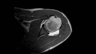 Labral tear in 20 year old [upl. by Fregger]