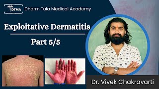 Dermatitis  Exfoliative Dermatitis Hindi  Types  Part 55 Eczema  Skin Disease  Skin Infection [upl. by Raychel]