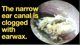 The narrow ear canal is clogged with earwaxear wax removal  ear cleaning  ASMR  relaxation [upl. by Gide]