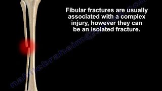 Fibular Fracture isolated Everything You Need To Know  Dr Nabil Ebraheim [upl. by Lhamaj558]