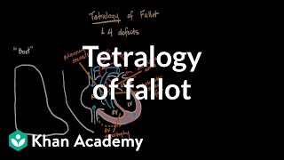 Tetralogy of fallot  Circulatory System and Disease  NCLEXRN  Khan Academy [upl. by Edahsalof532]