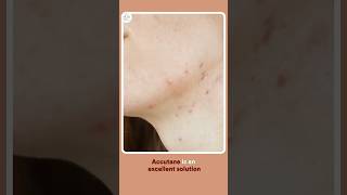 Accutane amp Skincare Essential Tips for Treating Acne [upl. by Clorinde192]