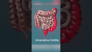 Understanding Crohns Disease vs Ulcerative Colitis [upl. by Llerret]