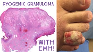 HUGE Pyogenic Granuloma lobular capillary hemangioma  extramedullary hematopoiesis Emory case 6 [upl. by Vogeley965]