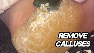 Dry Callus Removing  satisfying callusremoval fyp shortsdiycallusremoval [upl. by Lucy784]