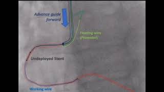 RCA ostium stenting [upl. by Lacee]