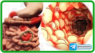 Inflammatory bowel disease IBD  Crohns disease and Ulcerative colitis [upl. by Cuttie]