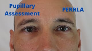 Pupillary Assessment PERRLA [upl. by Nerte]