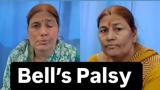 Bell’s Palsy Patient Review Recovery Dr Pritam Singh  Jigars physiotherapist [upl. by Goldshell]