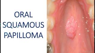 Oral Squamous Papilloma  Benign Tumour of Epithelial Tissue I Dental Guide I Dr Bimal Chand I [upl. by Hayidan]