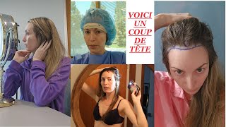 Jai fait des implants capillaires 👨🏻‍🦲🌱sur un coup de tête calvitie chirurgieesthetique chauve [upl. by Asenaj]