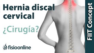 Hernia Discal Cervical cuándo optar por la cirugía u operación quirúrgica [upl. by Henrietta]