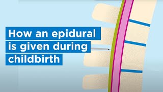 How an epidural is given during childbirth  Bupa Health [upl. by Tram]