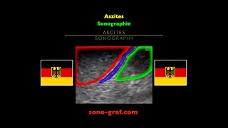 Sonographie Aszites [upl. by Jadda]