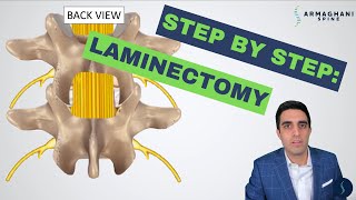 Step by step how to perform a lumbar laminectomy [upl. by Bartholemy]