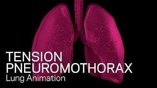 Tension Pneumothorax  Medical Animation [upl. by Lawson375]