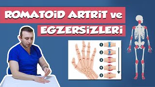 Romatoid Artrit  İltihaplı Eklem Romatizması  En Faydalı Egzersizler [upl. by Pia]