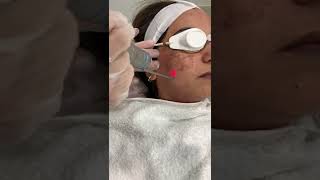 QSwitched Laser Toning pigmentation removal [upl. by Eirallih]