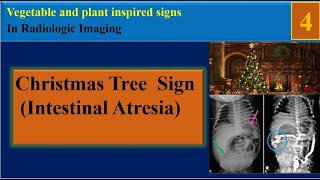 Christmas Tree Sign  Applepeel Intestinal Atresia [upl. by Yecnahc]