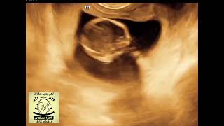 Axillary lymphangioma fetal ultrasound [upl. by Haleigh]