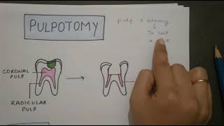 FORMOCRESOL PULPOTOMY IN HINDI [upl. by Nyleak]