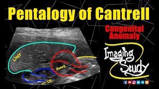 Pentalogy of Cantrell  Gastroschisis  Ectopia Cordis  Ultrasound  Anomaly  Case 289 [upl. by Leanatan253]