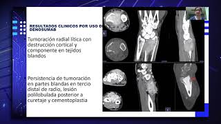 El uso del Denosumab en tumores de células gigantes [upl. by Libre]