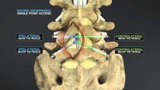 Medical Animation of Lumbar Stenosis Decompression [upl. by Fenelia]