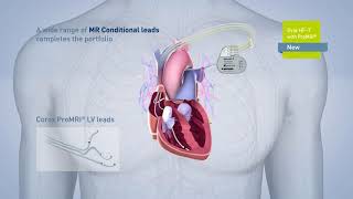 Biotronik pacemaker EVIA [upl. by Nhguav139]