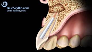 Patient Treatment Videos Apicoectomy [upl. by Nojel]