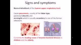 Streptococcus pneumoniae infection and disease [upl. by Prudy]