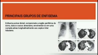 Enfisema Pulmonar  Série trabalhos dos meus alunos  29102024 [upl. by Markiv]